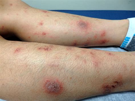 dermatitis numular - que es la dermatitis atopica